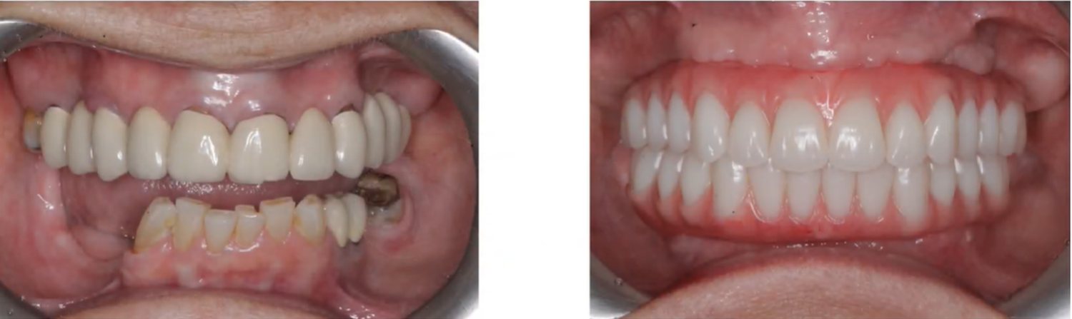 Antes e depois de reabilitação oral total realizada na Clínica Odontológica Raposo