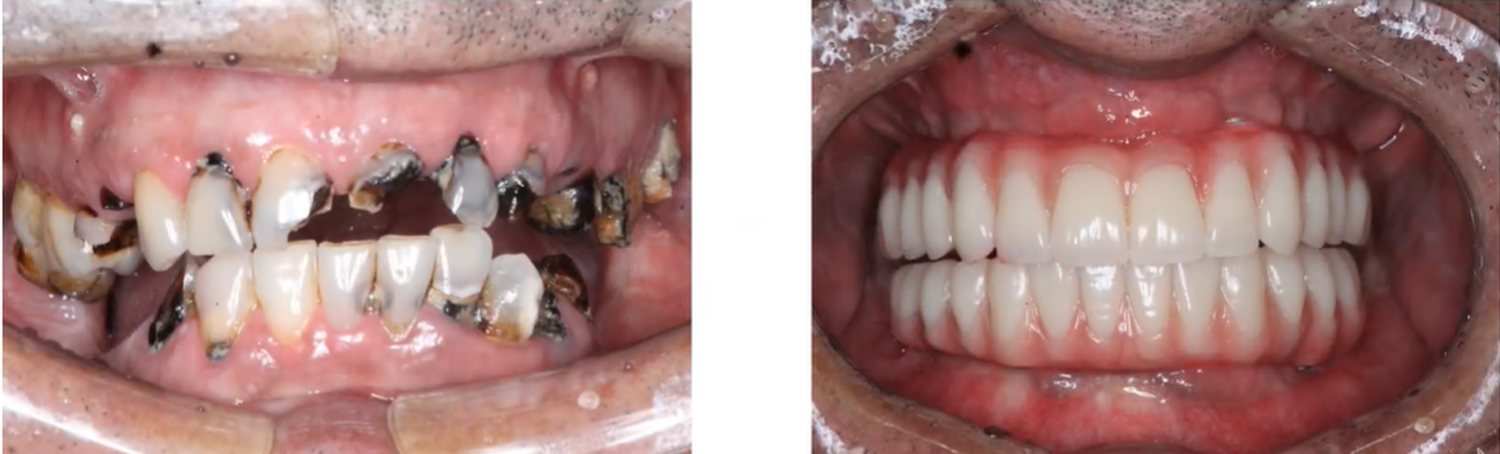Antes e depois de reabilitação oral total realizada na Clínica Odontológica Raposo