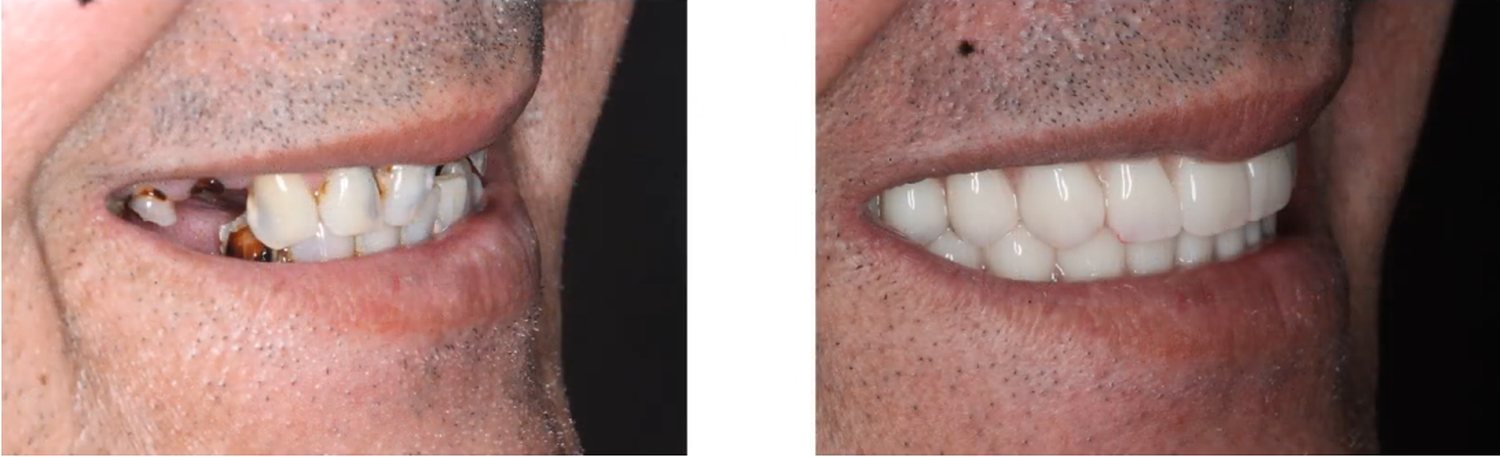 Antes e depois de protocolo total · vista lateral realizada na Clínica Odontológica Raposo