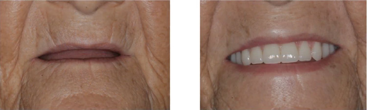 Antes e depois de protocolo total superior realizada na Clínica Odontológica Raposo